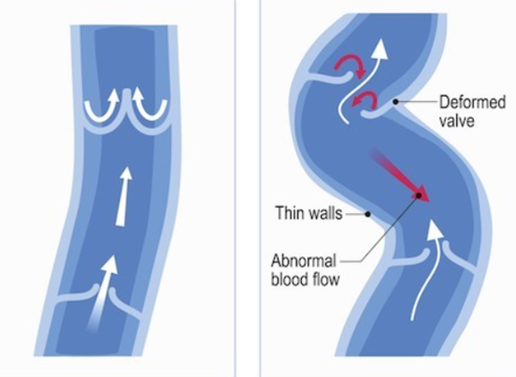 varicose veins schematic