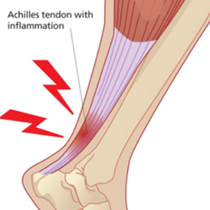 achilles tendonitis schematic